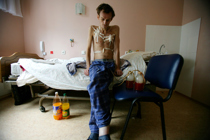 Киев, 12 августа 2005 г. 25-летний Дмитрий, у которого уже четвертая стадия ВИЧ, принимал наркотики с 16 лет. Сейчас он лечится от хронической зависимости и сопутствующих заболеваний в Киевском городском центре СПИДа (больница № 5), медицинском учреждении с наилучшим оснащением для больных СПИДом. В больнице современное оборудование, но проблемы с квалифицированными врачами. Низкие зарплаты и боязнь ВИЧ/СПИДа среди медицинских работников означают, что оборудование в клинике на данный момент не используется в полной мере. Зарплата ведущего доктора 200$ в месяц, что считается нормальной зарплатой по местным меркам. Но многие молодые медики не готовы работать за такие деньги.