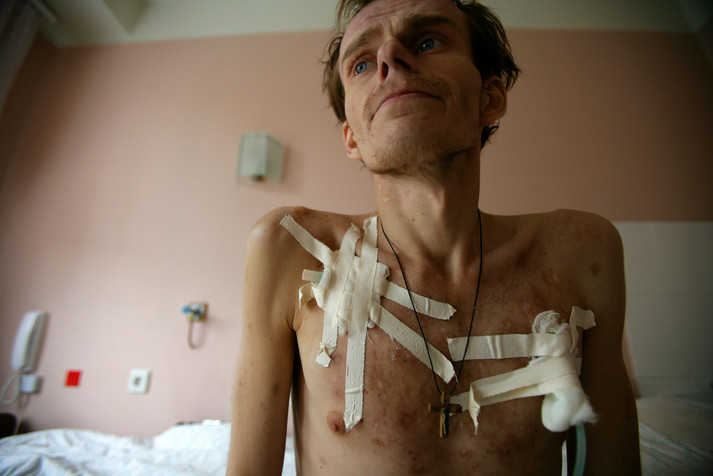 Киев, 12 августа 2005 г. 25-летний Дмитрий, у которого уже четвертая стадия ВИЧ, принимал наркотики с 16 лет. Сейчас он лечится от хронической зависимости и сопутствующих заболеваний в Киевском городском центре СПИДа (больница № 5), медицинском учреждении с наилучшим оснащением для больных СПИДом. В больнице современное оборудование, но проблемы с квалифицированными врачами. Низкие зарплаты и боязнь ВИЧ/СПИДа среди медицинских работников означают, что оборудование в клинике на данный момент не используется в полной мере. Зарплата ведущего доктора 200$ в месяц, что считается нормальной зарплатой по местным меркам. Но многие молодые медики не готовы работать за такие деньги.