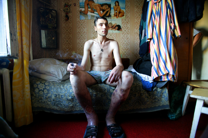 Полтава, 12 августа 2005 г.
Пораженные инфекцией ноги наркозависимого Игоря, 37 лет, который воевал в Афганистане. Там он начал употреблять наркотики и сегодня его жизнь крутиться вокруг его маленькой квартирки и обеспечения его потребностей в наркотиках. Он не уверен, есть ли у него ВИЧ-инфекция, но у него сложная форма сепсиса, множество других заболеваний, связанных с употреблением наркотиков.