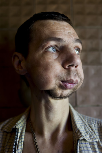 Харьков, август 2011.
Влад, 43 года. С 13 лет на наркотиках – начинал с марихуаны, сейчас на винте. Лишился нижней челюсти из-за инфекции, вызванной грязными компонентами самодельных наркотиков. Проблемы с челюстью – побочный эффект употребления винта.